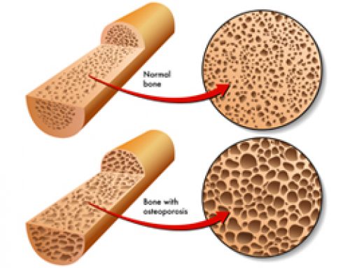 Osteoporosis: The Calcium Connectio