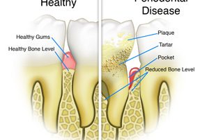 Healthy Teeth vs Periodontal Disease