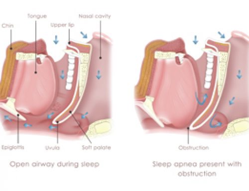 What is Sleep Apnea?