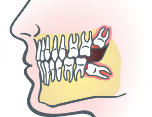 Wisdom Teeth Removal